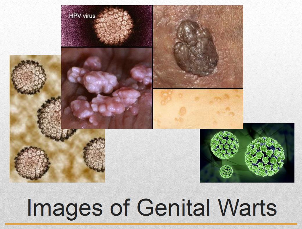 Stages Of Genital Warts